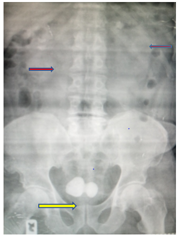 Urinary Bladder Calculus In An Adult Male Patient Presenting With ...