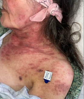 A person lying down with a red rash on her neck

AI-generated content may be incorrect.
