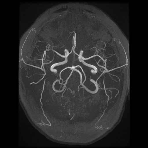 An x-ray of a brain

AI-generated content may be incorrect.