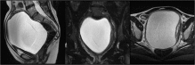 Fig. 1. A magnetic resonance scan of the pelvis before the second operation