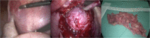 Fig. 2. (A) Dissection of the myometrium performed by monopolar electrocautery