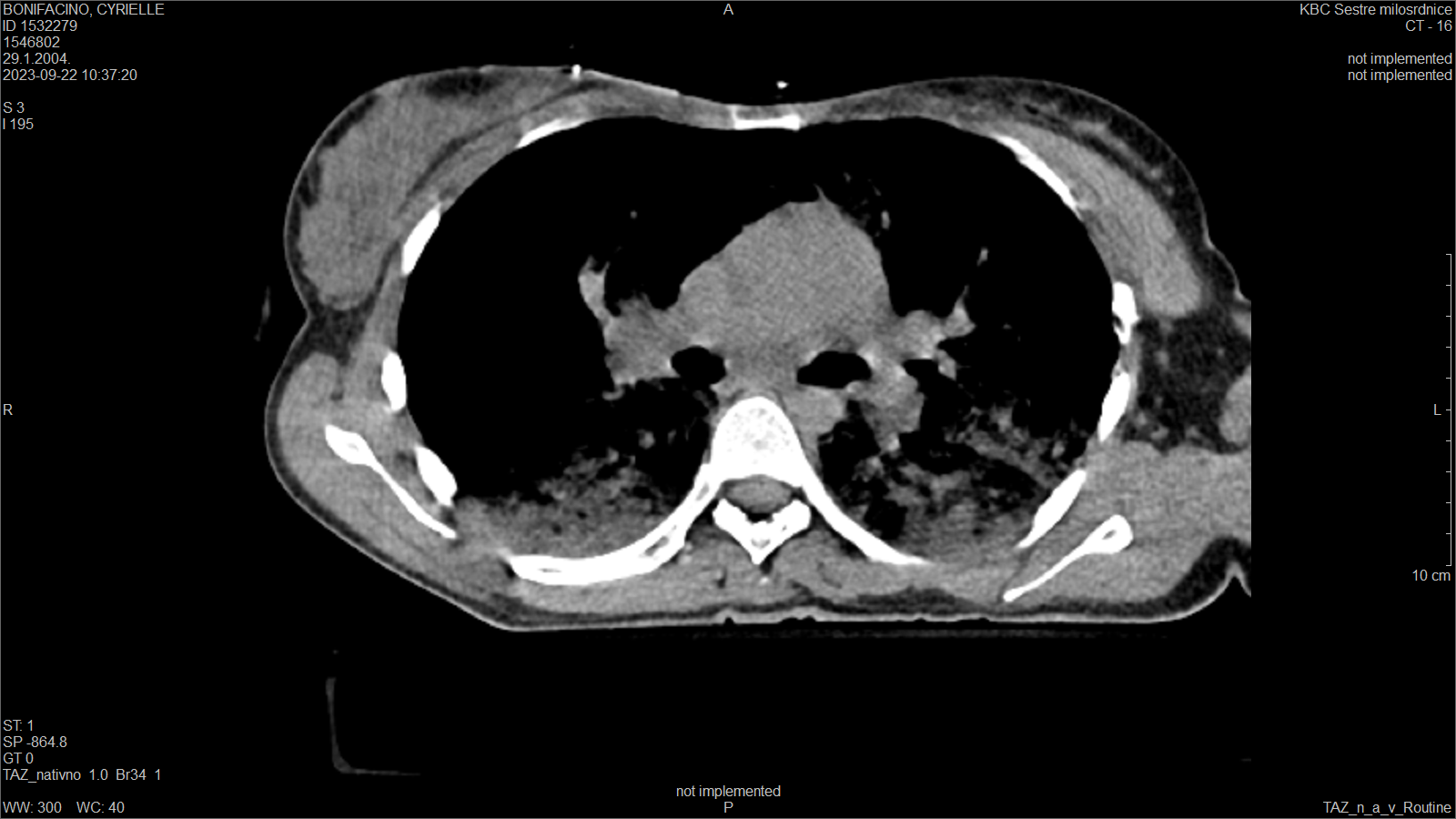 A close-up of a chest x-ray

Description automatically generated