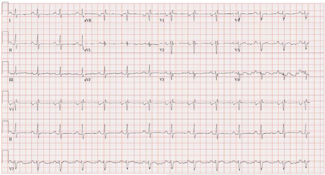 A graph of a heart rate

AI-generated content may be incorrect.